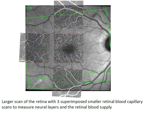 Larger scan of the retina with 3 superimposed smaller retinal blood capillary scans to measure neural layers and the retinal blood supply 